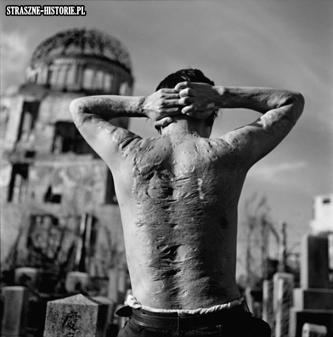 Blizny na plecach człowieka, który przetrwał atak nuklearny na Hiroszimę.